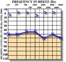 Audiogram – konduktiv tip eşitmə zəifliyi