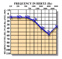 Audiogram – sensorinevral tip eşitmə zəifliyi