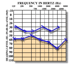 Audiogram – mikst tip eşitmə zəifliyi
